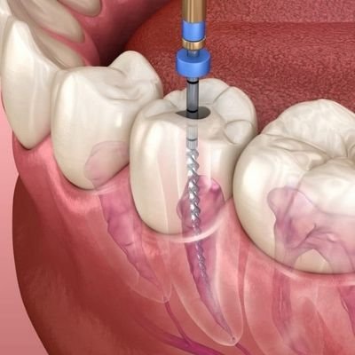 Tratamiento de conducto Rosario Santa Fe