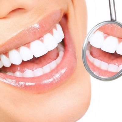 Blanqueamiento dental