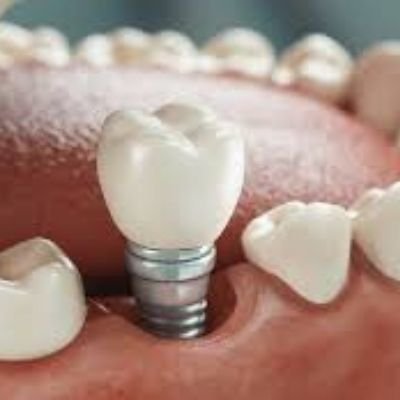 Implante dental en Rosario Santa Fe